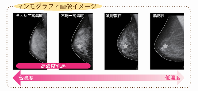 マンモグラフィ画像イメージ