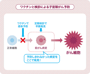 ワクチンと検診で子宮頸がん予防